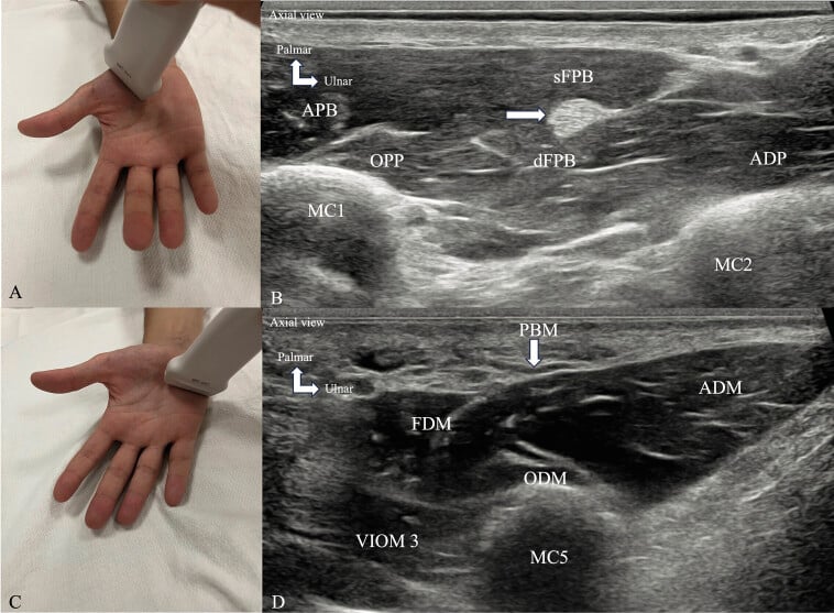 Probe positions and axial ultrasound showing normal thenar and hypothenar muscle layers including ADM