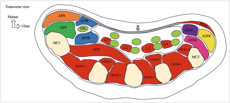 Transverse schematic of thenar, hypothenar, lumbrical and interosseous muscles at metacarpal level