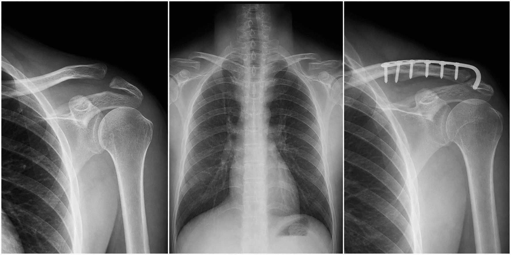 AC joint injuries visual summary for Clinical Imaging