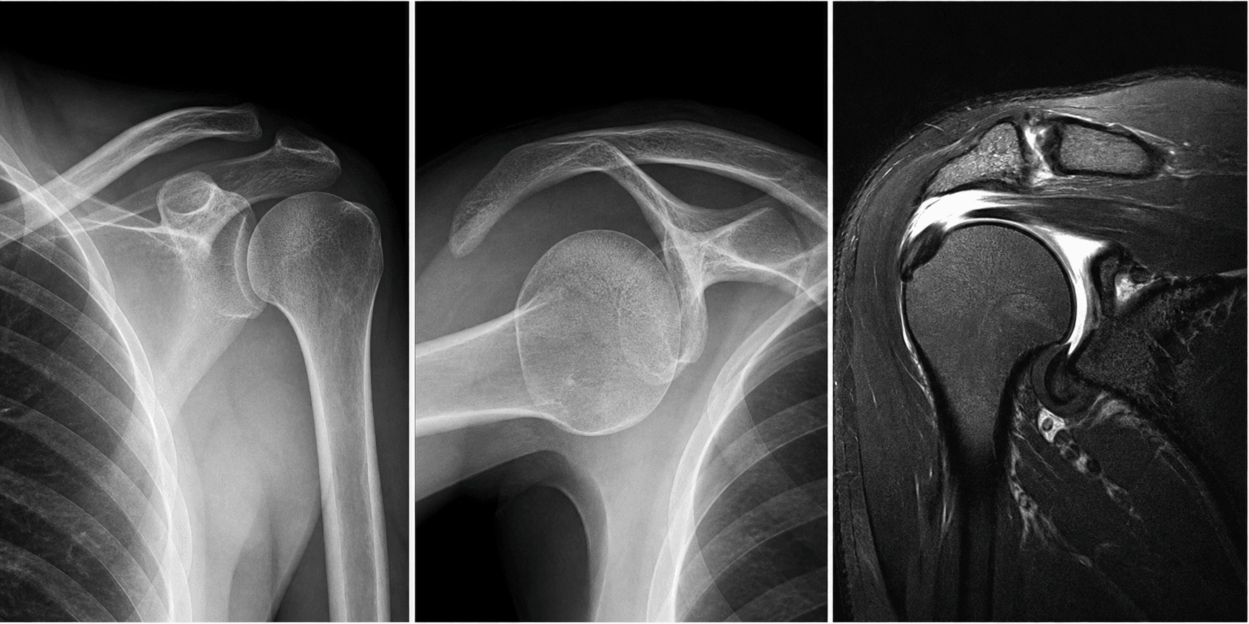 AC joint injuries visual summary for Investigations