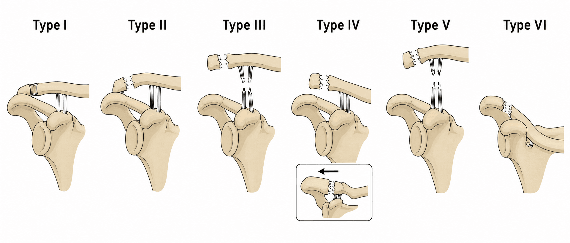 Rockwood classification of acromioclavicular joint injury, Types I to VI, shown on the clavicle, acromion and coracoid