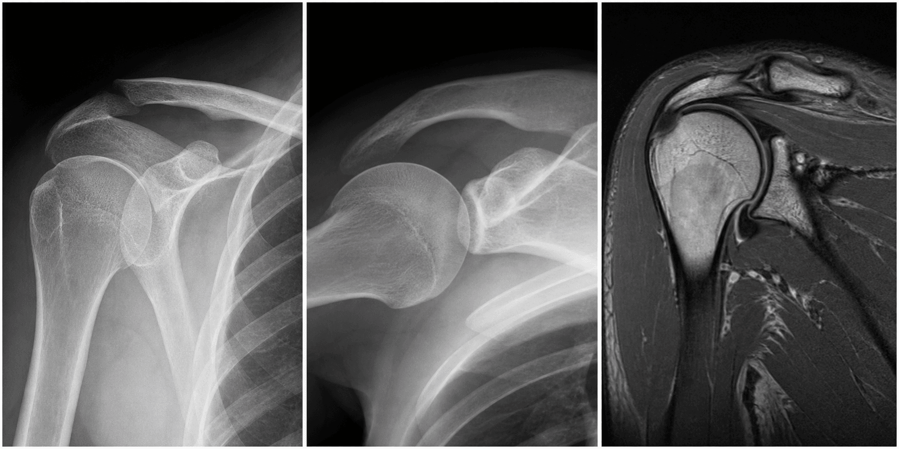 AC joint injuries in athletes visual summary for Investigations in Athletes