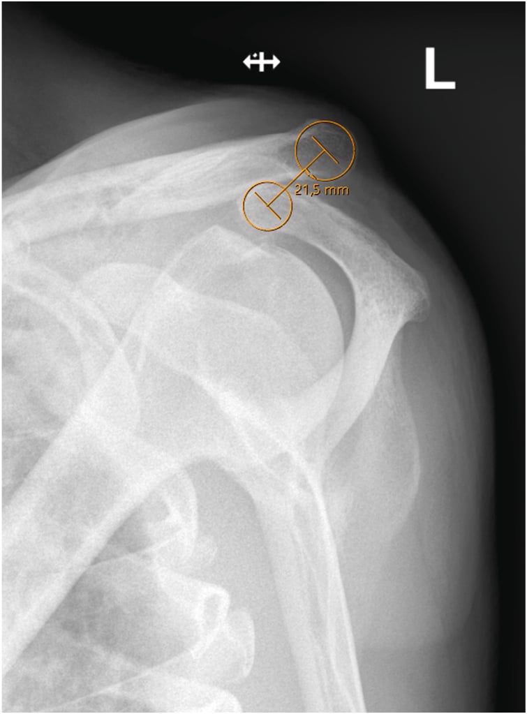 Alexander cross-body adduction radiograph with circle-centre measurement demonstrating horizontal instability of the acromioclavicular joint.