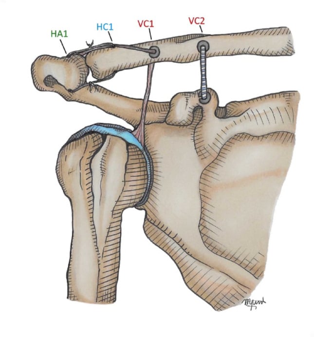 Schematic of coracoclavicular suspensory fixation, acromioclavicular cerclage and graft tunnel placement in anatomic AC joint reconstruction.