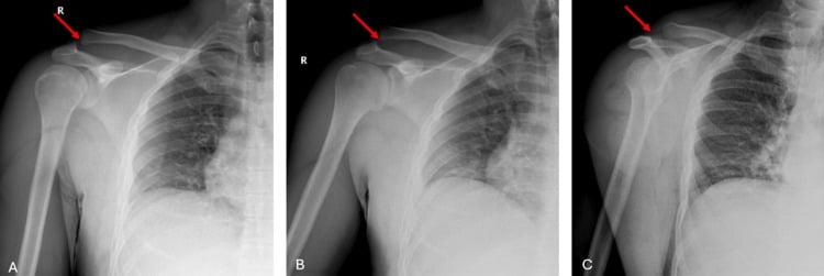 Three plain radiographs of an acromioclavicular joint dislocation in AP, true AP and axial rotation views.