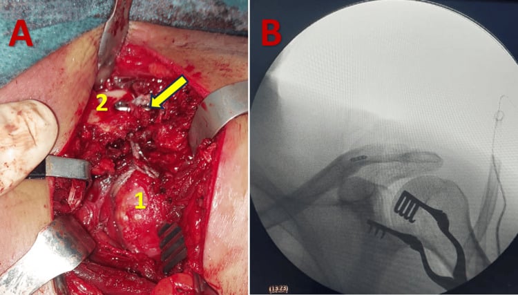 Intraoperative photograph and fluoroscopic image showing an Endobutton construct between the clavicle and coracoid for AC joint stabilisation.