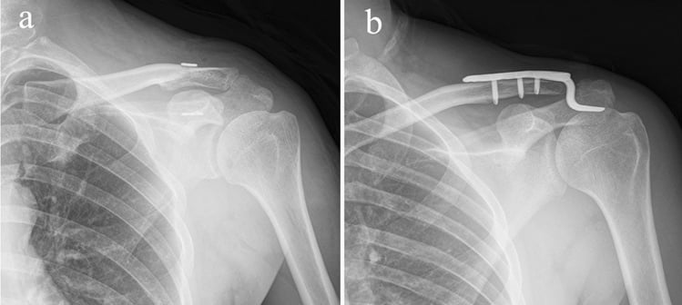 Immediate postoperative radiographs comparing minimally invasive TightRope fixation with clavicular hook-plate fixation for acromioclavicular dislocation.