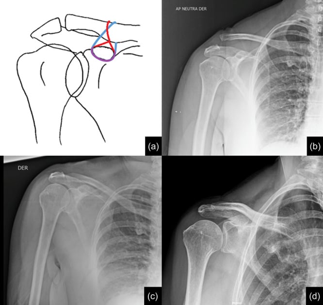 Schematic and serial radiographs showing a suture-based AC joint repair before surgery, immediately after over-reduction and at one-year follow-up.