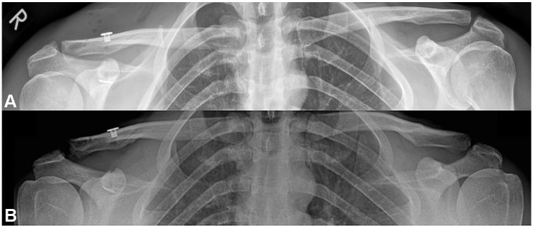 Panoramic shoulder radiographs comparing early postoperative over-reduction after TightRope stabilisation with later loss of AC joint reduction.