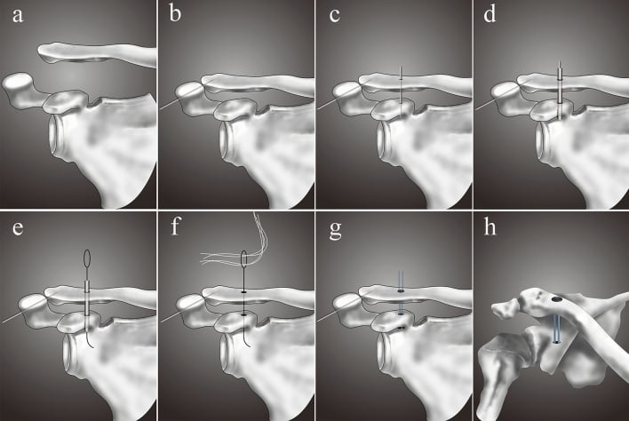 Eight-panel schematic sequence for transclavicular-coracoid drilling, suture shuttling and TightRope fixation of an acromioclavicular dislocation.