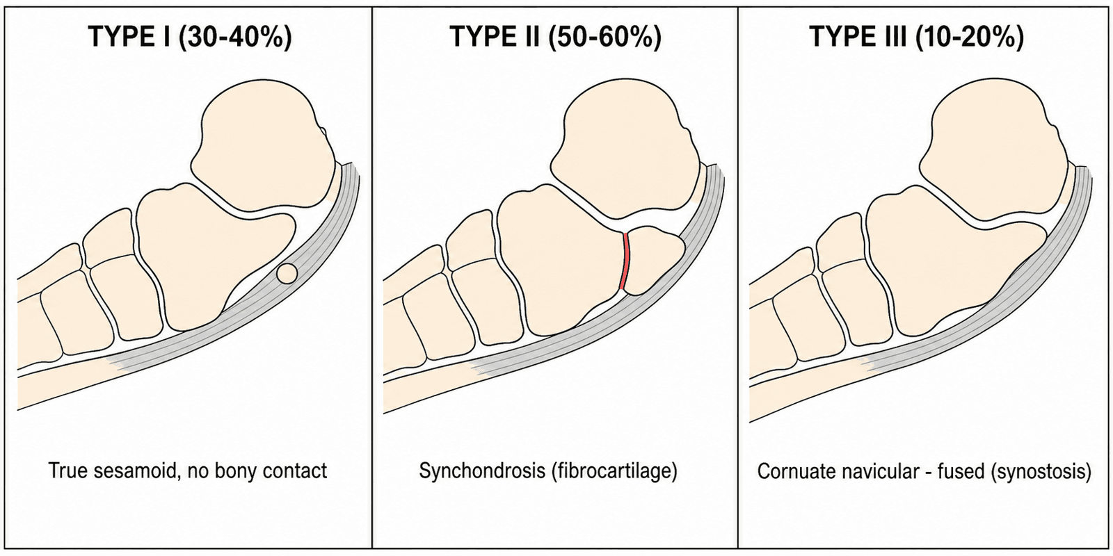 Schematic of the Geist classification of accessory navicular Types I, II and III showing increasing bony attachment