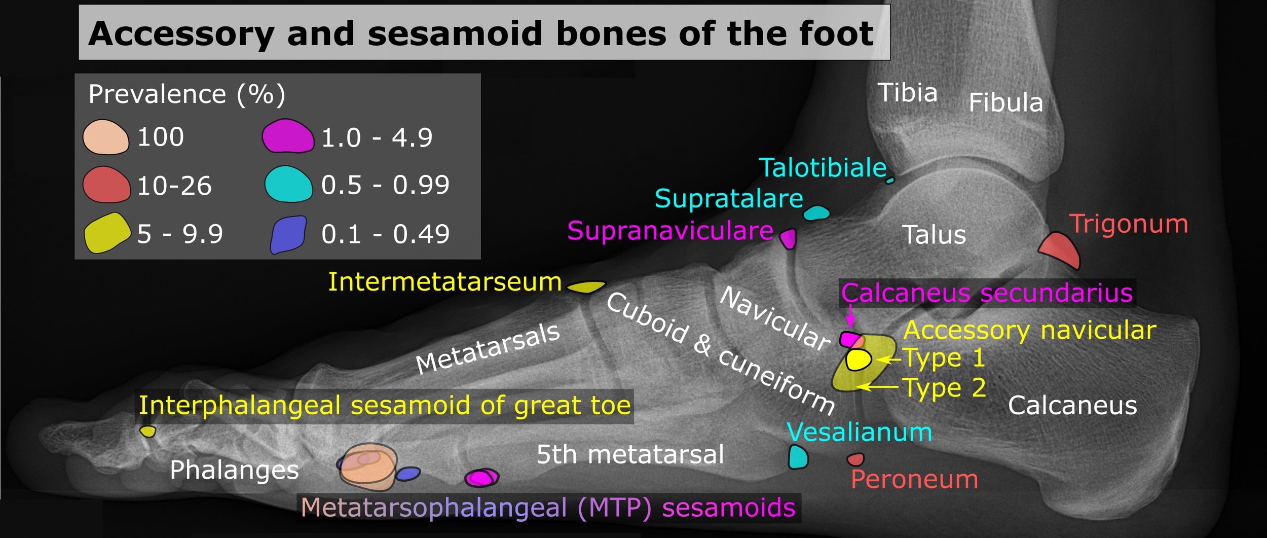 Lateral foot X-ray showing accessory navicular Type 1 and Type 2 locations