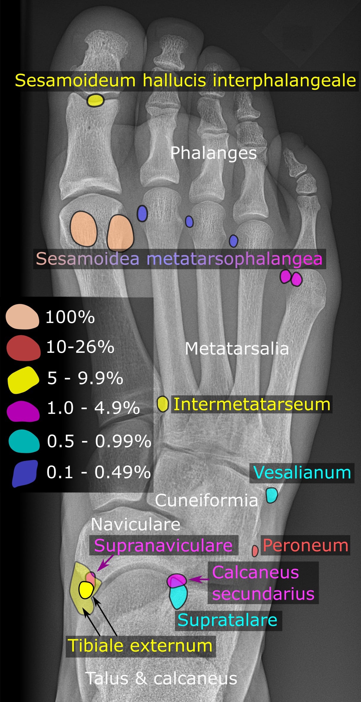 AP foot X-ray showing accessory navicular location