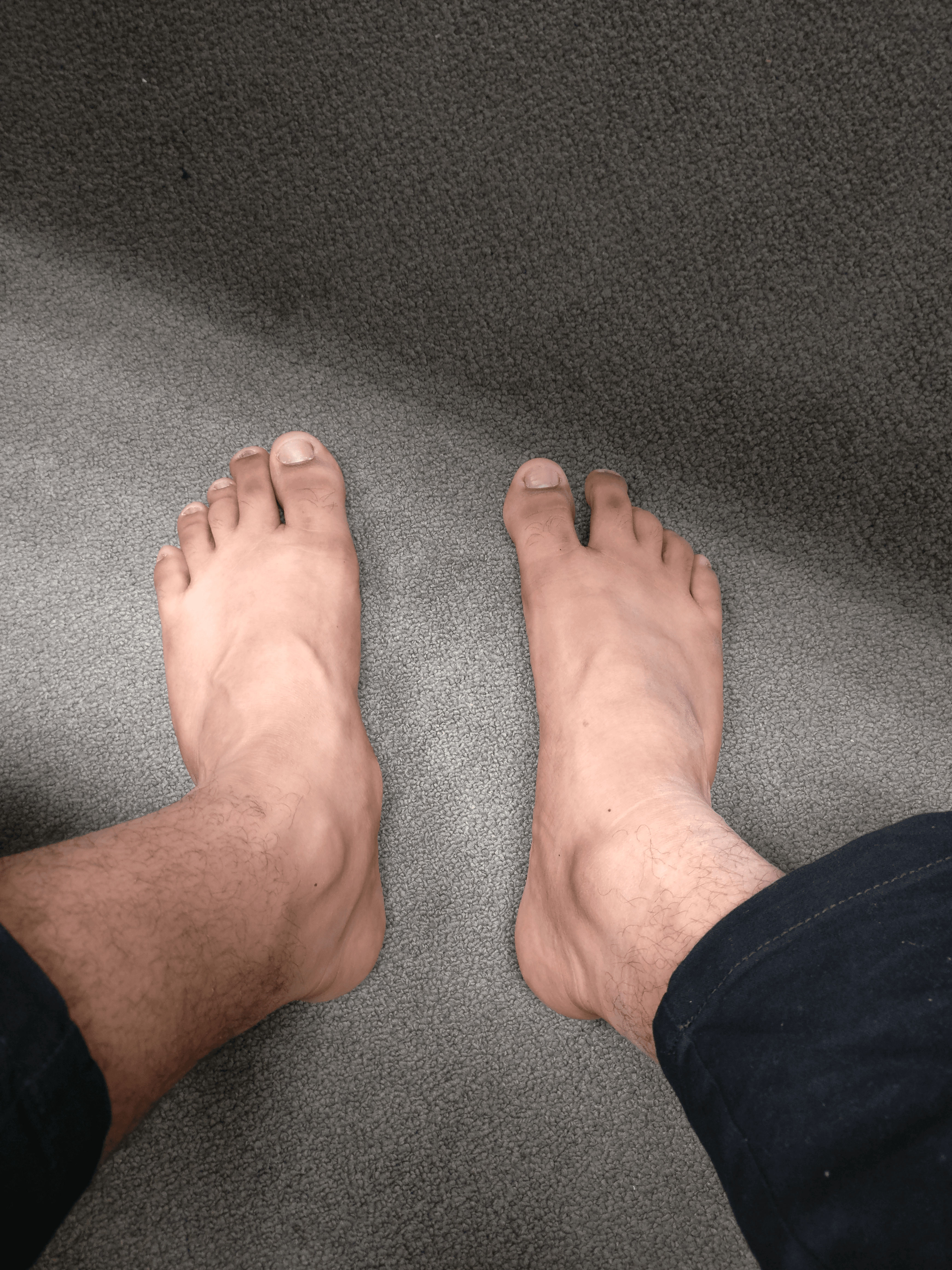 Clinical photograph comparing a foot with a prominent accessory navicular against a normal foot