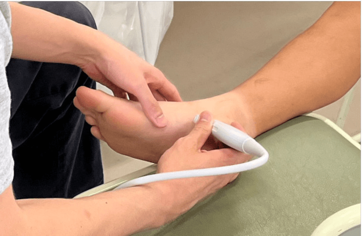 Photograph of ultrasound probe placement on the medial midfoot