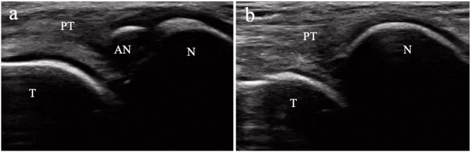 Ultrasound comparison showing an accessory navicular proximal to the navicular beneath the posterior tibial tendon, beside a view without one