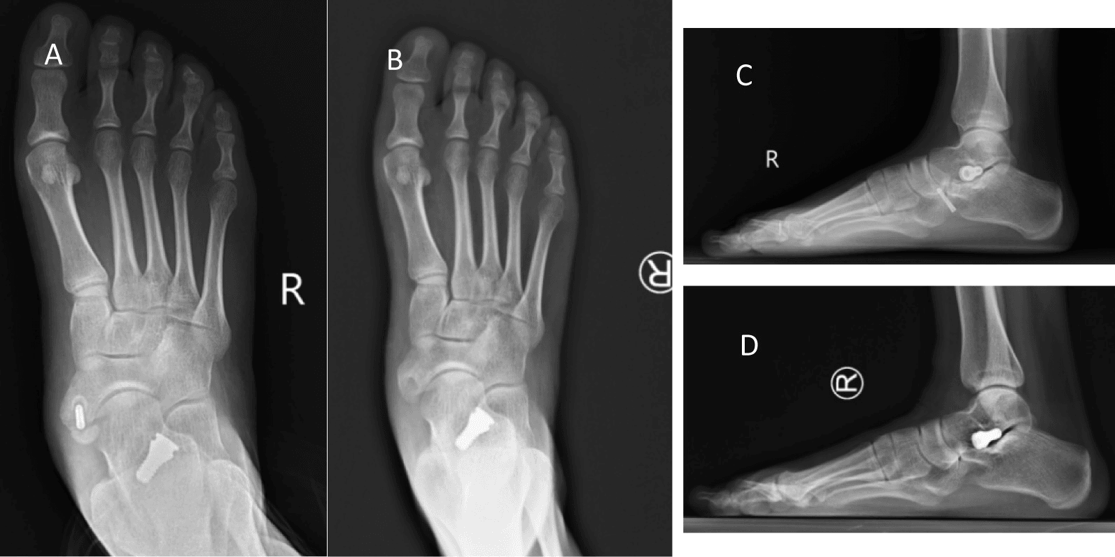 Radiographs showing nonunion after screw fixation of an accessory navicular and revision by screw removal and ossicle excision