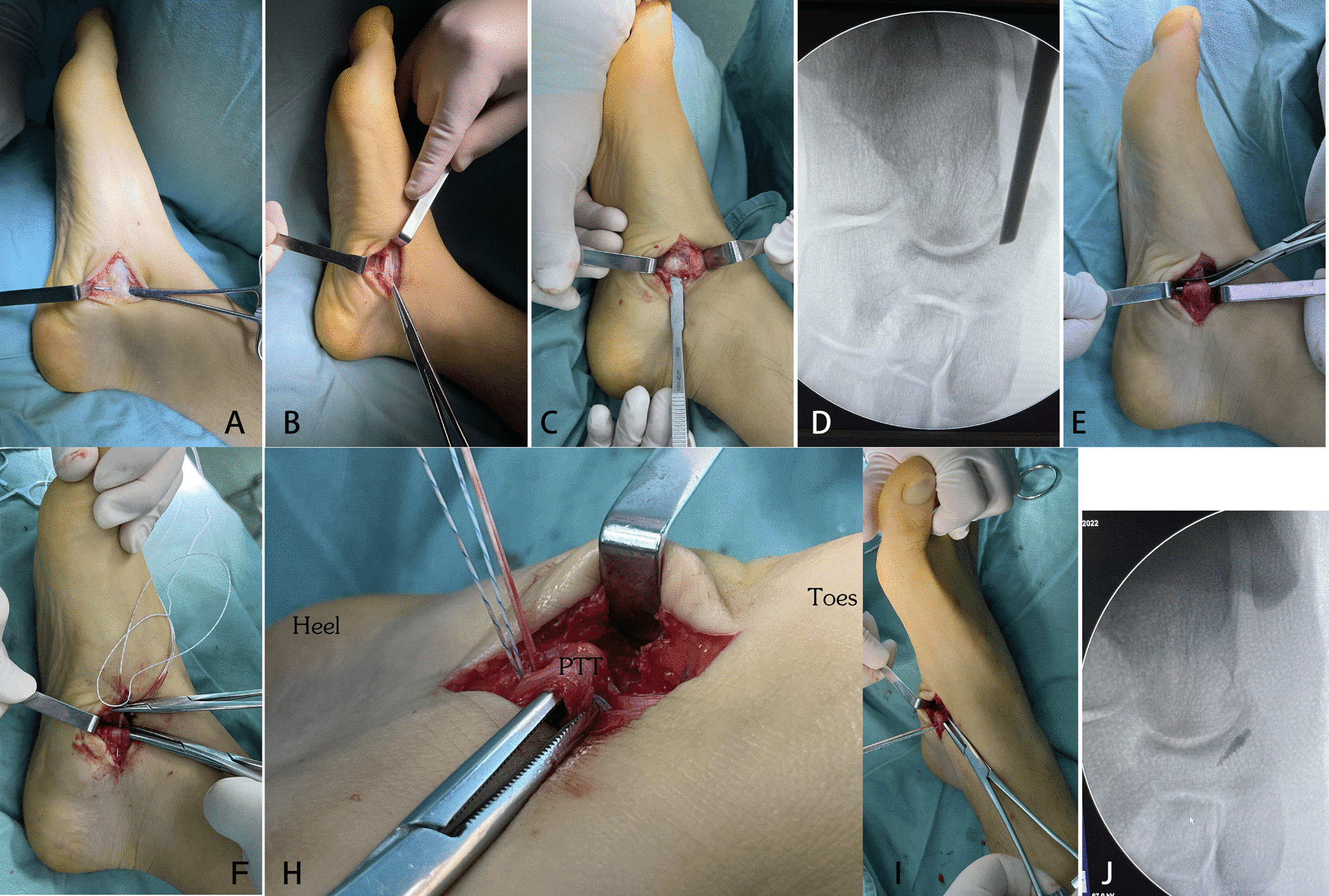 Intraoperative sequence showing medial incision, posterior tibial tendon exposure, fluoroscopy and suturing of the tendon