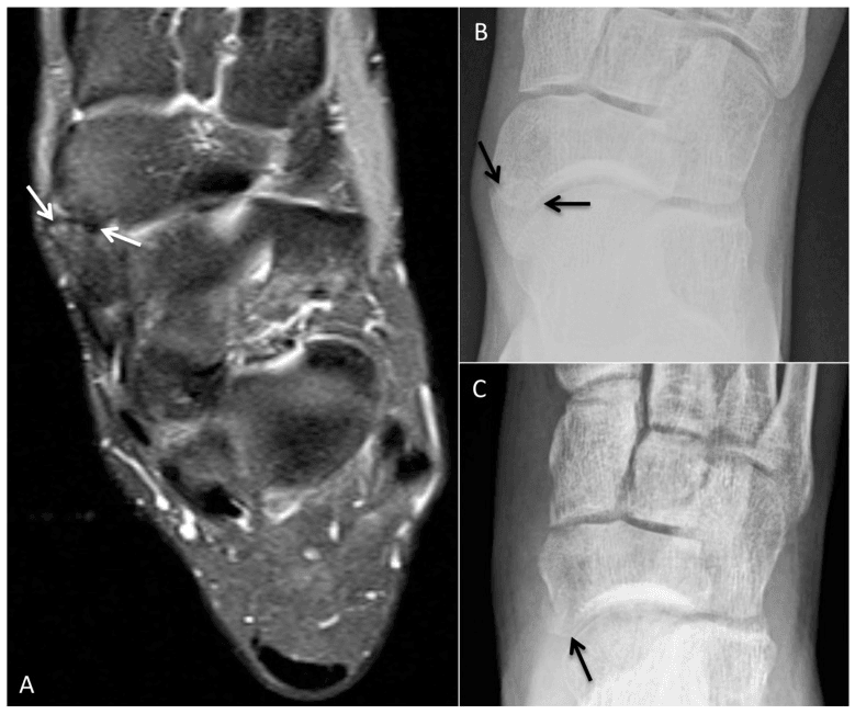 Preoperative MRI and radiograph of a symptomatic type II accessory navicular with a postoperative radiograph after resection