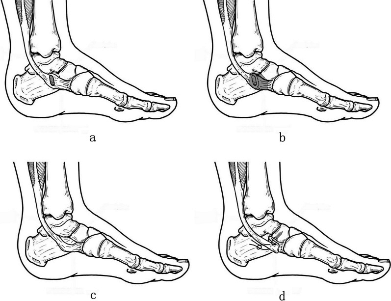 Schematic of accessory navicular resection with posterior tibial tendon insertion preservation and folded suture-anchor reconstruction