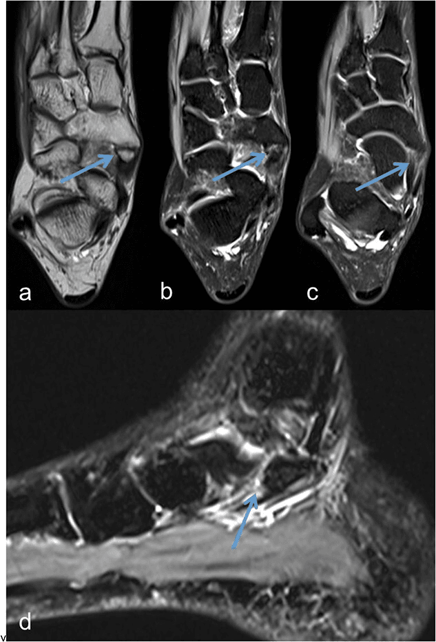MRI of a symptomatic type II accessory navicular with and without fat suppression, the lesion arrowed in each panel
