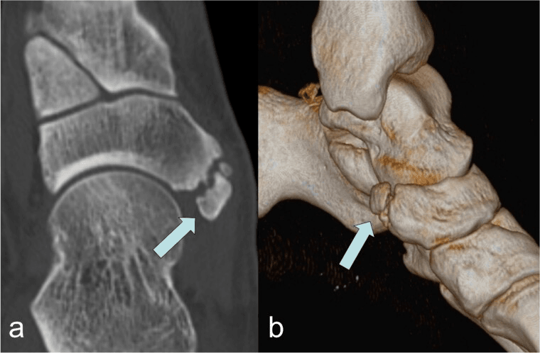 CT and 3D reconstruction showing a type II accessory navicular joined to the navicular by a synchondrosis