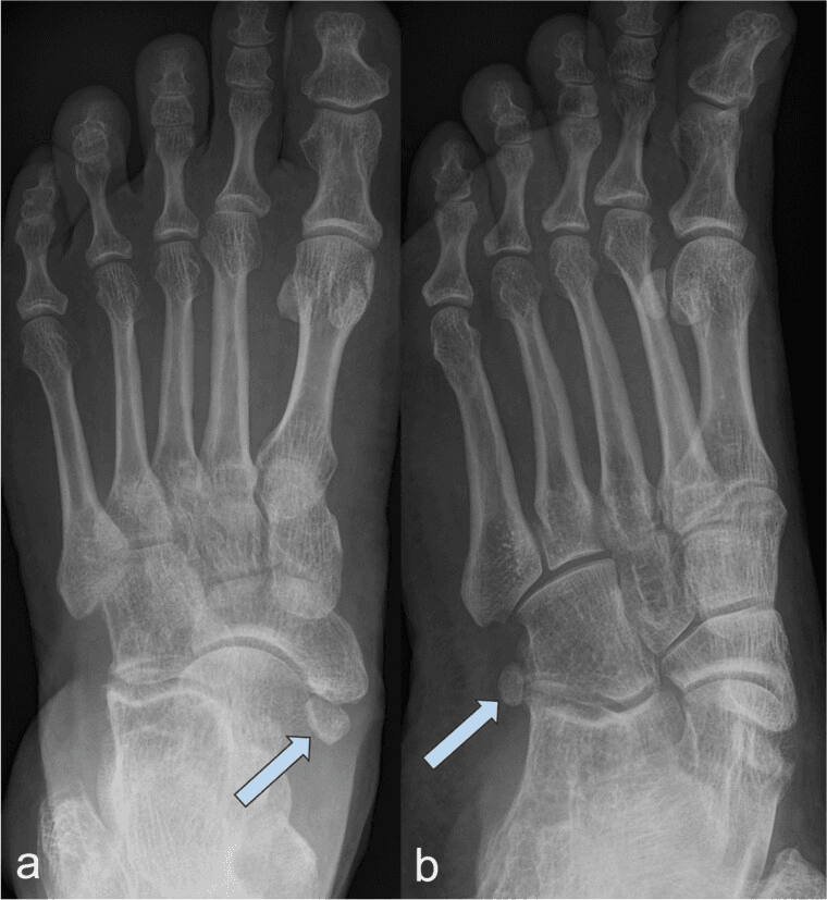 AP and oblique foot radiographs showing a type II accessory navicular beside the navicular tuberosity
