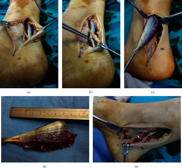 Posteromedial excision of an accessory soleus with tarsal tunnel decompression and visualisation of the tibial neurovascular bundle
