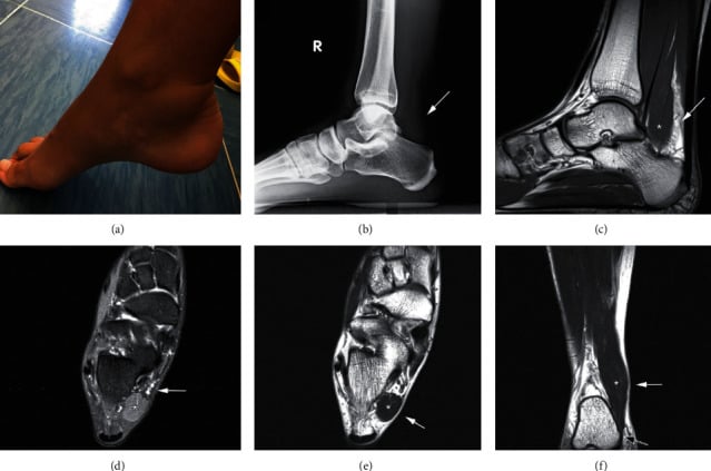 Clinical radiographic and MRI appearance of an accessory soleus causing posteromedial ankle swelling