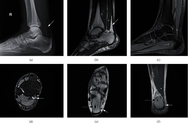 Radiographic and multiplanar MRI findings of an accessory soleus presenting with pain and paraesthesia but no visible swelling