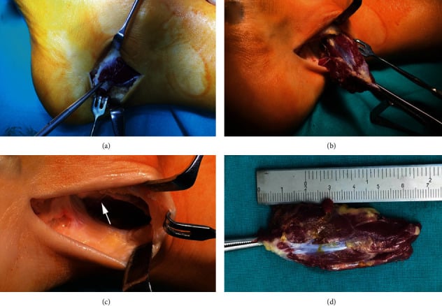 Posteromedial operative exposure complete excision and specimen of a symptomatic accessory soleus