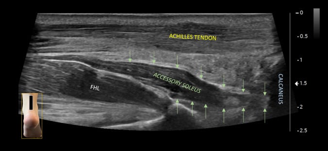 Long-axis ultrasound showing the accessory soleus belly and separate tendon anterior to the Achilles tendon