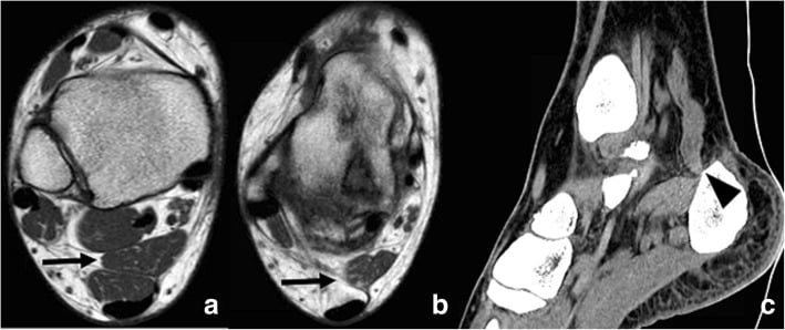 Axial T1 MRI and sagittal CT showing an incidental accessory soleus and its medial calcaneal insertion