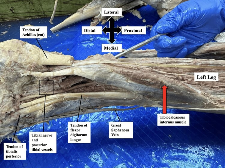 Cadaveric posteromedial leg showing a tibiocalcaneus internus soleus variant beside the posterior tibial neurovascular bundle
