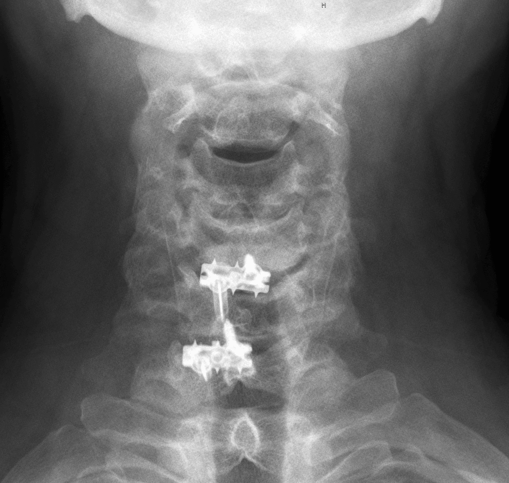 AP cervical radiograph of the same two-level ACDF construct.