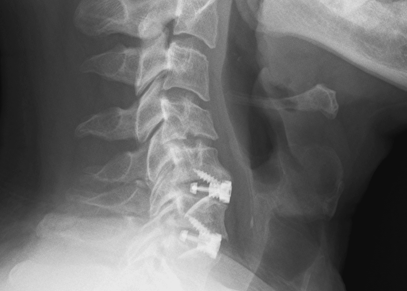 Lateral cervical radiograph after a two-level ACDF with interbody cages and an anterior plate at C5-6 and C6-7.