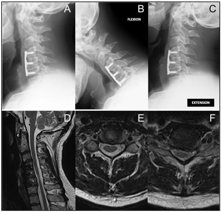 Neutral, flexion and extension radiographs with MRI showing adjacent-level disc herniation after ACDF.