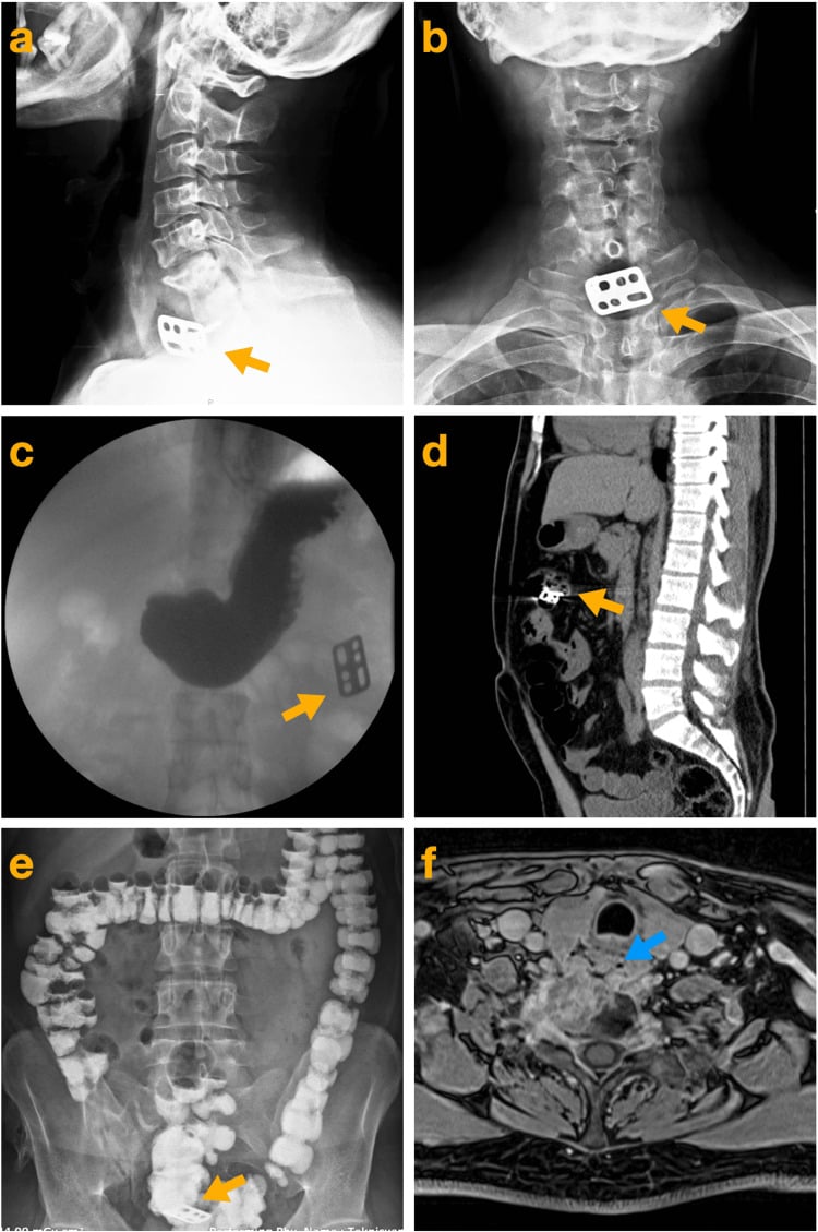 Radiographs, contrast esophagography and CT showing migration of an anterior cervical plate into the gastrointestinal tract.