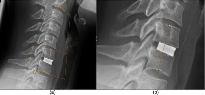Neutral lateral cervical radiographs with C2-C7 Cobb, segmental Cobb and fused-level height measurements.