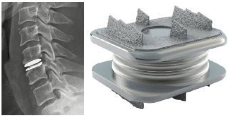 Lateral cervical radiograph after C5-C6 disc arthroplasty beside an artificial cervical disc.