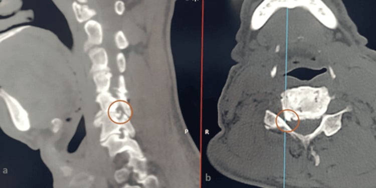 Sagittal and axial CT showing a C5-C6 cervical osteophyte.