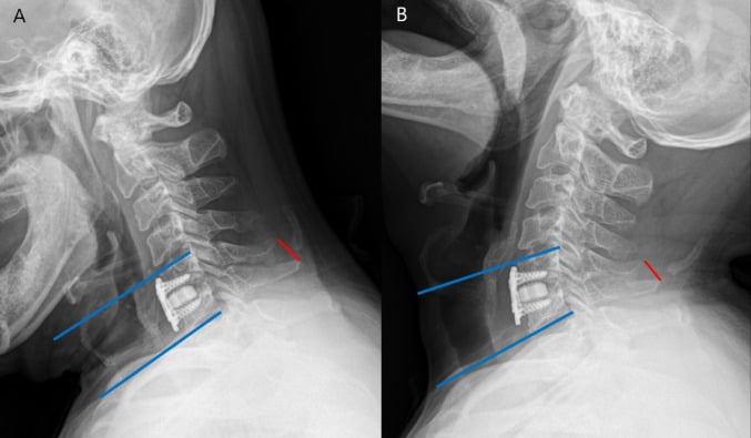 Flexion and extension lateral cervical radiographs with interspinous-distance and segmental-angle measurements across a fused level.