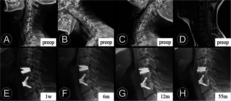 Preoperative and postoperative lateral images of two-level hybrid cervical surgery combining fusion and disc arthroplasty.
