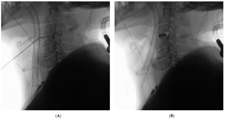 Intraoperative lateral fluoroscopic radiographs localising the C3-C4 disc space before ACDF.