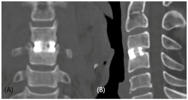 Coronal and sagittal reconstructed CT at 12 months after single-level C3-C4 ACDF showing bridging bone across the fused disc space.