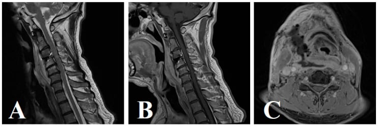 Postoperative MRI showing a prevertebral fluid collection after C3-C4 ACDF.