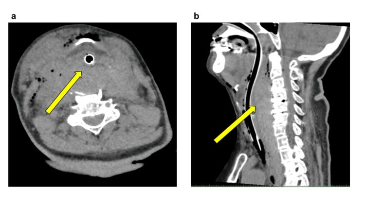 Axial and sagittal CT showing a retropharyngeal haematoma compressing the airway after ACDF.