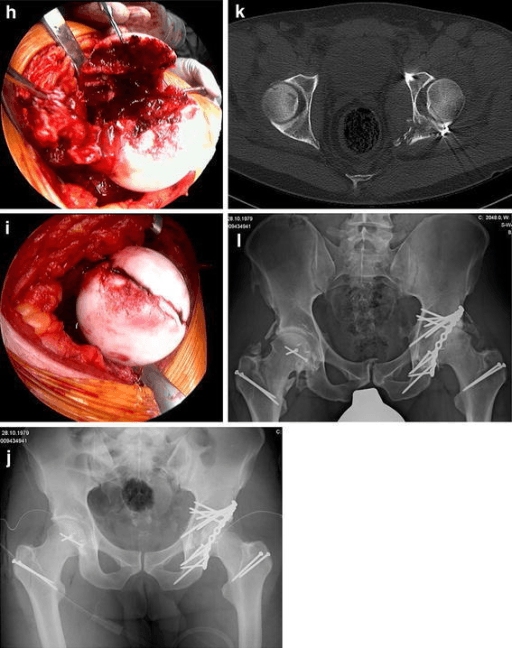 Intraoperative photos of posterior acetabular exposure with radiographs