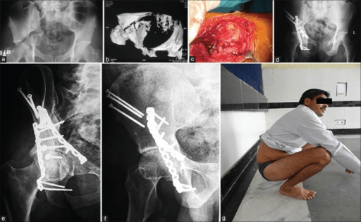 Acetabular fracture imaging and surgical approach demonstration