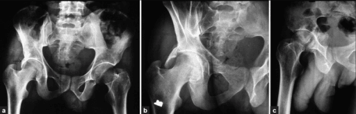 Pelvic radiographs showing acetabular fracture with posterior wall fragment